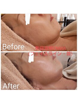 エステティックサロン やまとなでしこ/美容溶解☆閻魔フェイシャル顔