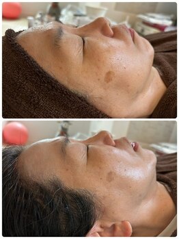 サロン ド グランツィア(salon de Granzia)/40代女性☆シミ・くすみ・たるみ