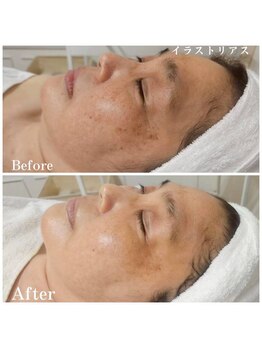 リリー(LILLY)/症例