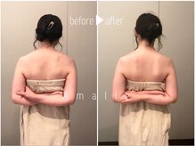 アマリエ/肩の盛り上がりを改善