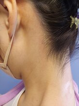 キアラ 麻布十番(Kiara)/うなじ脱毛のafter