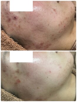 リノ(Lino)/肌荒れケア