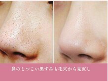 モアビューティー 庚午店(MORE BEAUTY)の雰囲気（快適な素肌を◎ニキビケア/凹凸/赤み/沈着改善）