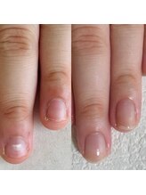 シーネイル(C Nail)/割れ爪・二枚爪などのお悩みに