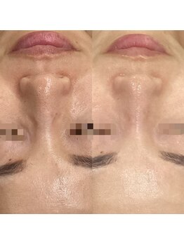 ランタン(Lantern)/毛穴ケアはハーブで改善！