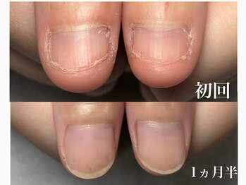 継続矯正中で2回目の施術