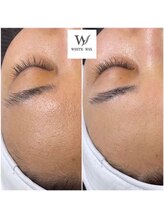 ホワイトワックス 京都四条烏丸(WHITE WAX)/透明感UP　美白ワックス