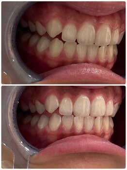 ユーラボ 表参道(YOU-LAB)/Befor/After【ホワイトニング】