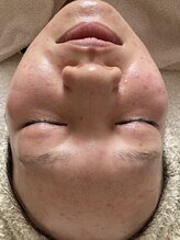 フィオラ(FIORA)/ニキビケア初回