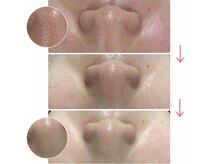 エヌエー 米子店(na)/肌質改善・黒ずみ毛穴ケア