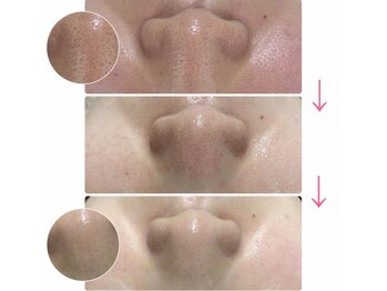 エヌエー 米子店(na)/肌質改善・黒ずみ毛穴ケア