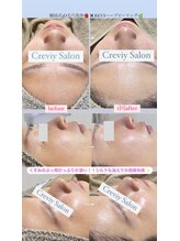 クレヴィー(Creviy)/3D毛穴洗浄×ハーブピーリング