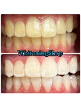 ホワイトニングショップ 吉祥寺2号店/ 少ない回数でも白くなる