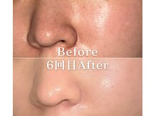 ミニョスキンラボ/韓国式ハーブピーリング6回