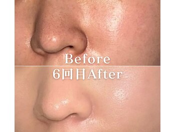 ミニョスキンラボ/韓国式ハーブピーリング6回