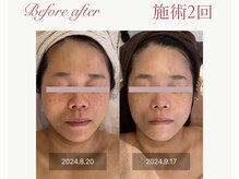 パルタージュ 三宮(Partage)/肌の改善に集中ケア