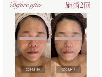 パルタージュ 三宮(Partage)/肌の改善に集中ケア