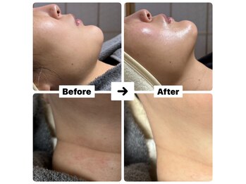 バイオ スキン プラス(Bio Skin Plus)