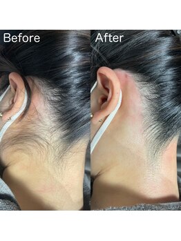 ア レーズ(a laise)/うなじワックス脱毛☆