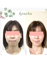 木の葉/40代/むくみ・輪郭・たるみ改善