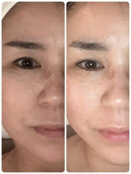 ココナチュレ(coconature)/ハーブピーリング&オプション