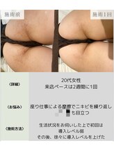 サロンエヌ 久留米店(Salon N)/黒ずみ改善