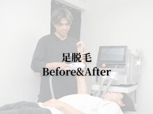 ボス 名古屋店(BOSS)/【足脱毛　before & after】