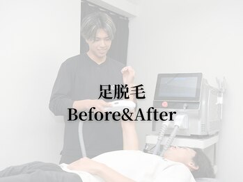 ボス 名古屋店(BOSS)/【足脱毛　before & after】