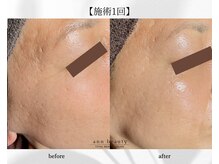 アン ビューティー(ann beauty)/施術1回【症例写真】