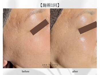 アン ビューティー(ann beauty)/施術1回【症例写真】