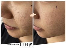 フルールドソレイユ(Fleur de Soleil)/毛穴・ニキビケアも好評☆