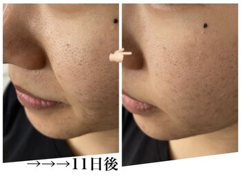 フルールドソレイユ(Fleur de Soleil)/毛穴・ニキビケアも好評☆