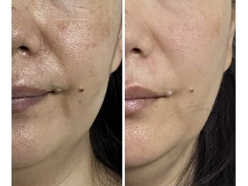 エッセンス(ESSENCE)/ピーリングマッサージ