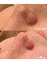 ルアナ(Luana)/脱★イチゴ鼻