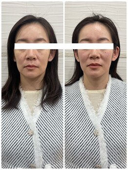 長寿鍼灸院 長寿整骨院/ハリネズミ女優美容鍼効果★