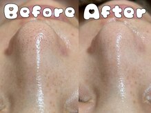 グラシア 倉敷店(Gracia)/ハイドラ毛穴洗浄