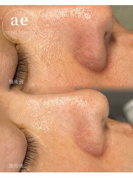 アエ(ae)/ダクトピール