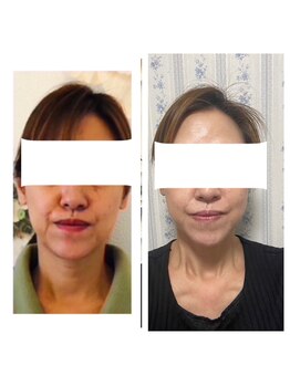 サロン ド ルポゼ(Salon de Reposer)/小顔矯正コース