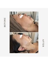 美時雨/むくみを改善しリフトアップ♪