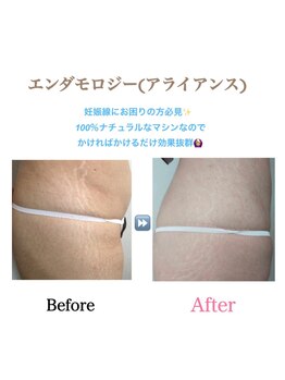 アイリス(AIRIS)/痩身/エンダモロジー/むくみ
