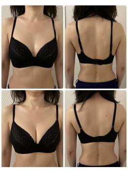 プレフィール(PLEAFEEL)/バストケア◇症例◇たまプラーザ