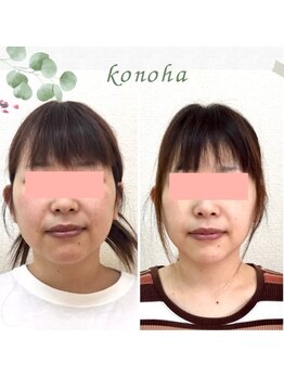 木の葉/20代/むくみ,輪郭，お顔を小さく