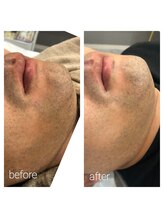 ナチュラル シャイン(NATURAL SHINE)/ひげ脱毛1回目から2回目