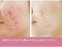 モアビューティー 庚午店(MORE BEAUTY)の雰囲気（本気の毛穴レスを目指しています！開き/黒ずみ/赤み/シミ改善）