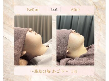 リーフ(Leaf.)/脂肪分解　あご下