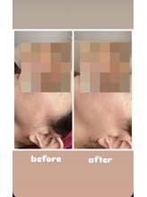 アンジュ(ANGE)/グレーズソフトピーリング症例