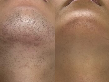 フェリス(FELIZ)/しつこいヒゲには