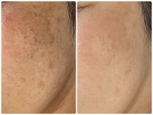 ヴィヴァン(Vivant)/シミケア★プラズマフェイシャル