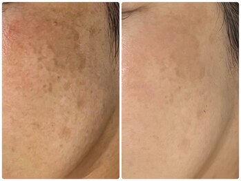 ヴィヴァン(Vivant)/シミケア★プラズマフェイシャル