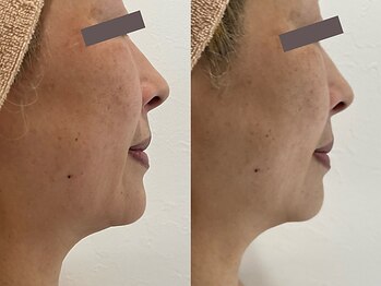 リボーン 柏(REBORN)/下半顔すっきりフェイスラインへ